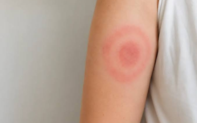 What to Do If You’re Bitten by a Tick: A Step-by-Step Guide.